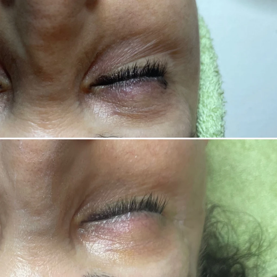 Before and after: crepey lines around the delicate eye area smoothed and hydrated