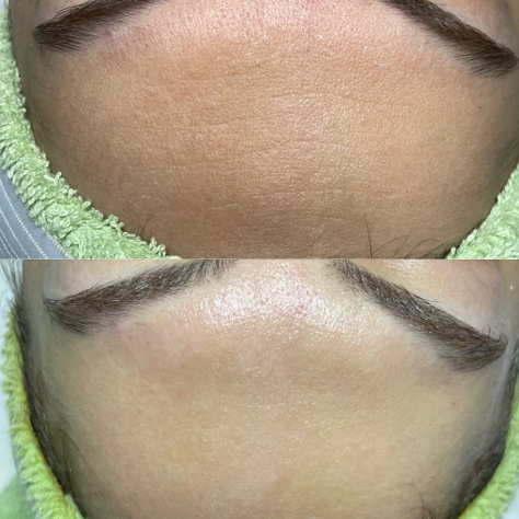 Before and after: forehead lines and uneven texture visibly softened