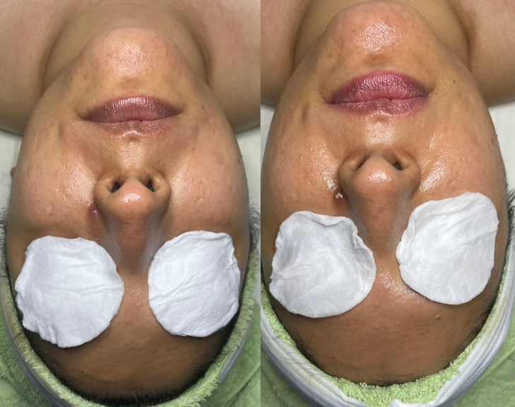 Before and after: skin around the mouth and chin looking plumped, hydrated and dewy