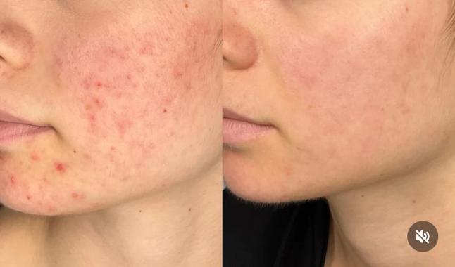 Before and after: inflamed redness and breakouts along the cheek and jaw calmed and cleared