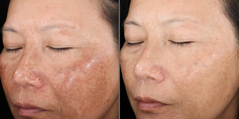 Before and after: heavy sun spots and pigmentation visibly faded across the cheeks