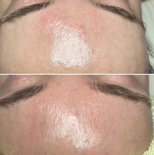 Before and after: dry, rough texture between the brows refined and evened out